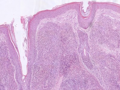 Histologie granuloma faciale