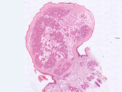 Histologie granuloma pyogenicum