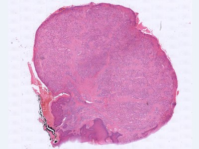 Histologie granuloma pyogenicum