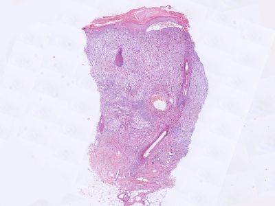 Histologie clear cell atypical fibroxanthoma