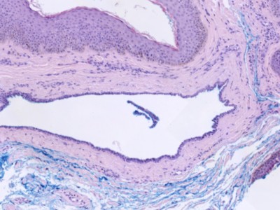 Histologie hidrocystoma