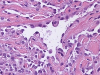 Histologie hobnail hemangioom