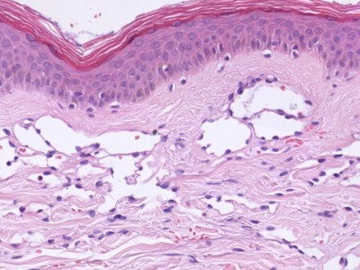 Histologie hobnail hemangioom