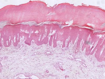 Histologie palmoplantaire hyperkeratose