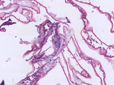 Histologie impetigo bullosa (blaardak)