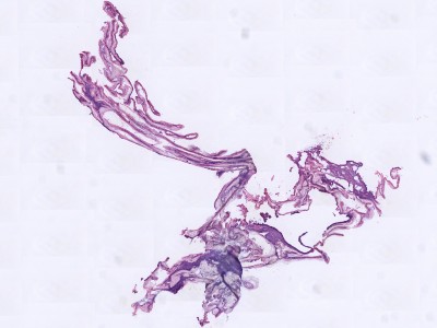 Histologie impetigo bullosa (blaardak)