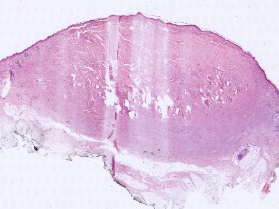 Histologie keloid