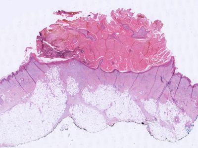Histologie keratoacanthoma