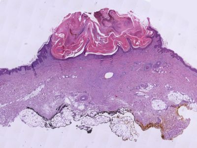 Histologie keratoacanthoma