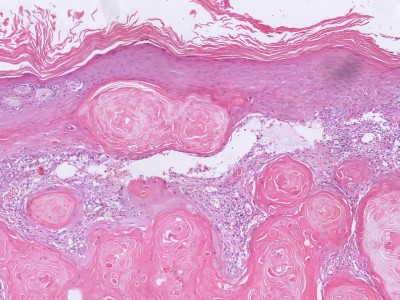 Histologie keratoacanthoma