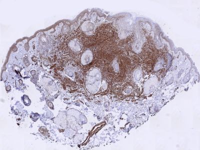 Histologie leiomyoma (ASMA kleuring)
