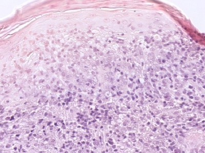 Histologie Leishmaniasis