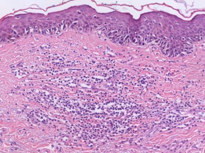 Histologie lentigo maligna melanoma