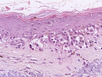 Histologie lentigo maligna