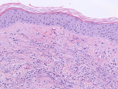 Histologie leukocytoclastische vasculitis