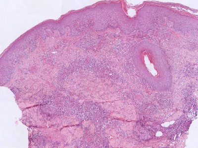 Histologie leukocytoclastische vasculitis