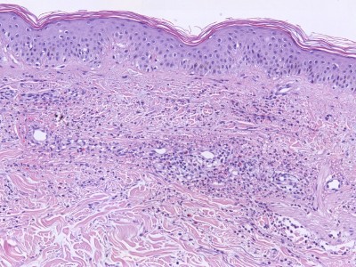 Histologie leukocytoclastische vasculitis