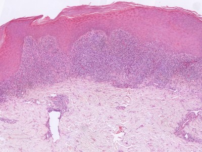 Histologie lichen planus