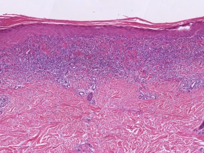 Histologie lichen planus