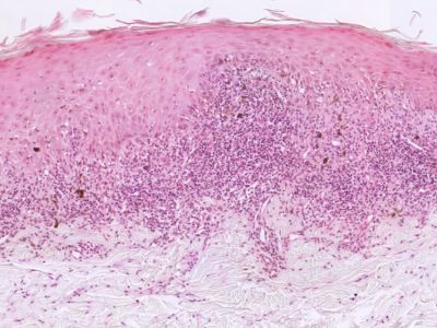 Histologie lichen planus