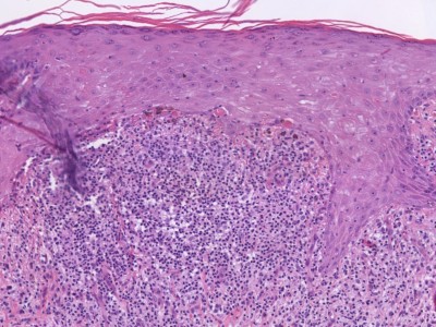 Histologie lichen planus