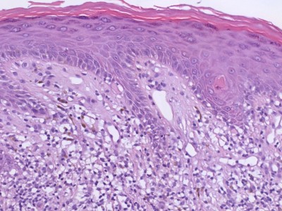 Histologie lichen planus