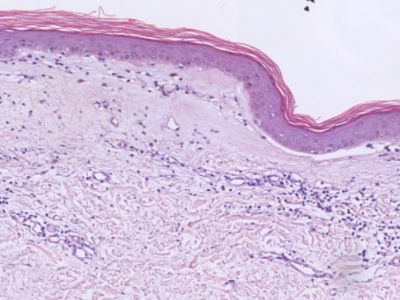 Histologie lichen sclerosus