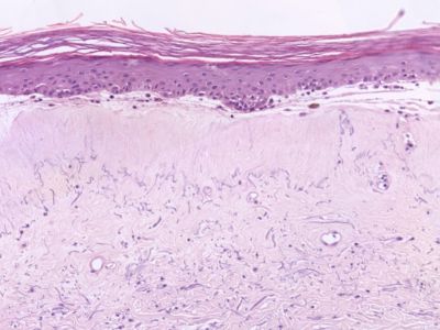 Histologie lichen sclerosus