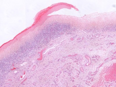 Histologie lichen sclerosus voorhuid