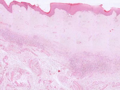 Histologie lichen sclerosus voorhuid