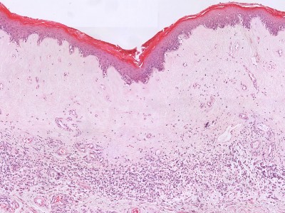 Histologie lichen sclerosus voorhuid
