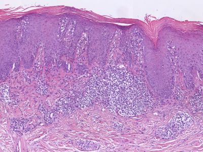Histologie lichen simplex chronicus