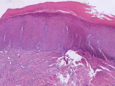 Histologie lichen simplex chronicus