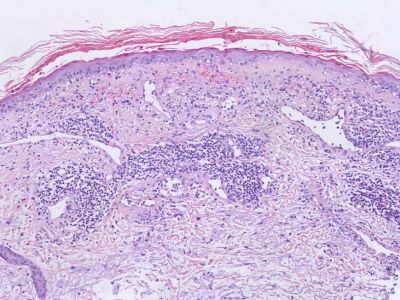 Histologie lupus erythematosus