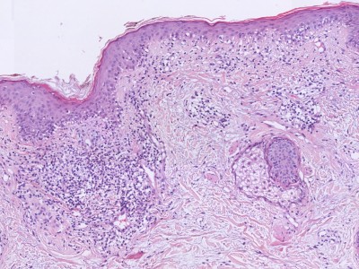 Histologie lupus erythematosus