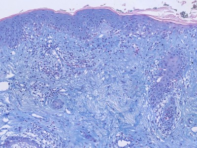 Histologie lupus erythematosus
