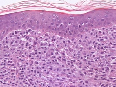 Histologie mastocytoma
