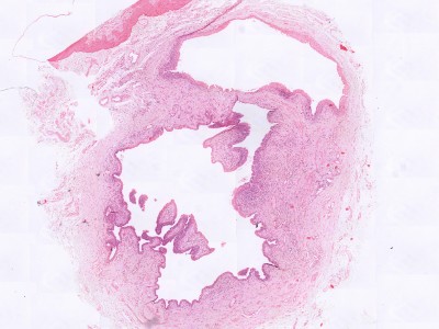 Histologie mediane raphe cyste