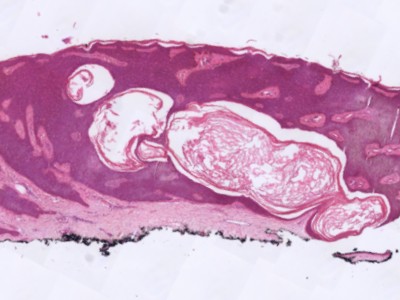 Histologie melanoacanthoma