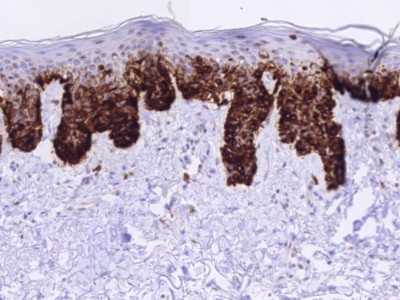 Histologie melanoma in situ (Melan A kleuring)