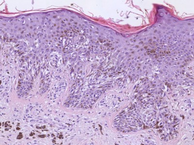 Histologie melanoma in situ