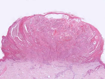 Histologie nodulair melanoma