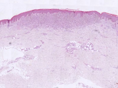 Histologie superficial spreading melanoma
