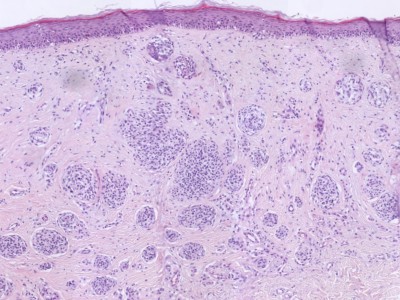 Histologie superficial spreading melanoma