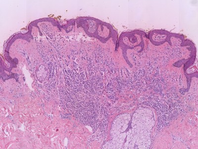 Histologie superficial spreading melanoma