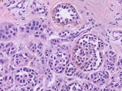 Histologie superficial spreading melanoma