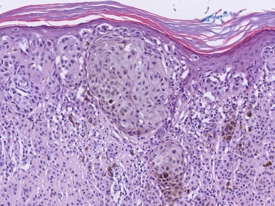 Histologie superficial spreading melanoma