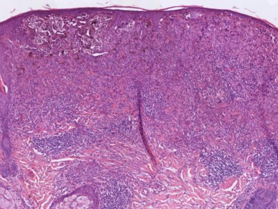 Histologie superficial spreading melanoma