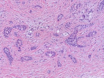 Histologie microcysteus adnexcarcinoom