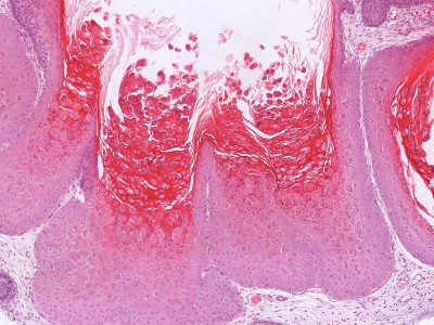 Histologie molluscum contagiosum